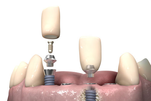 Implantologia stomatologiczna Amigodenta